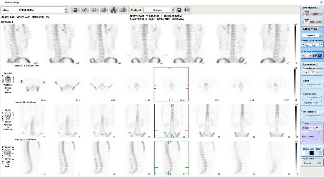 Bone - SPECT