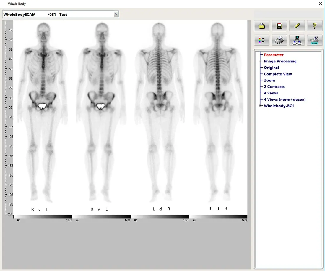 Bone - Whole Body Scan