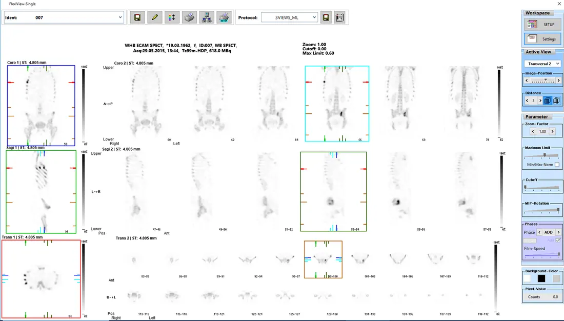 Bone - Wholebody SPECT