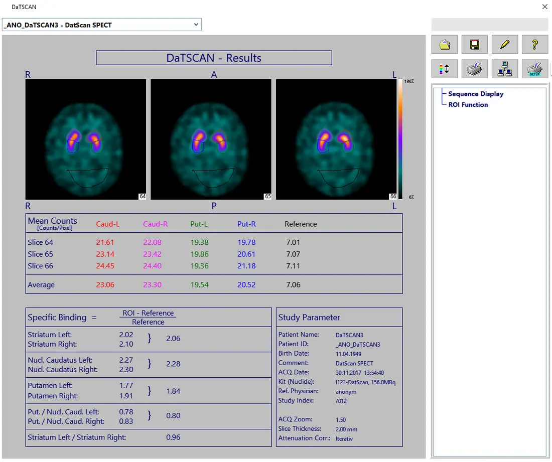 Brain SPECT