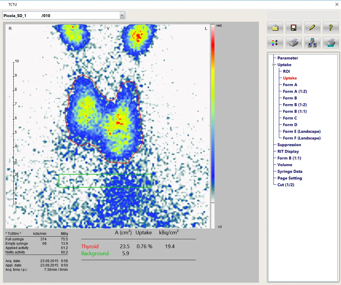 Thyroid - Scintigraphy and Uptake Calculation