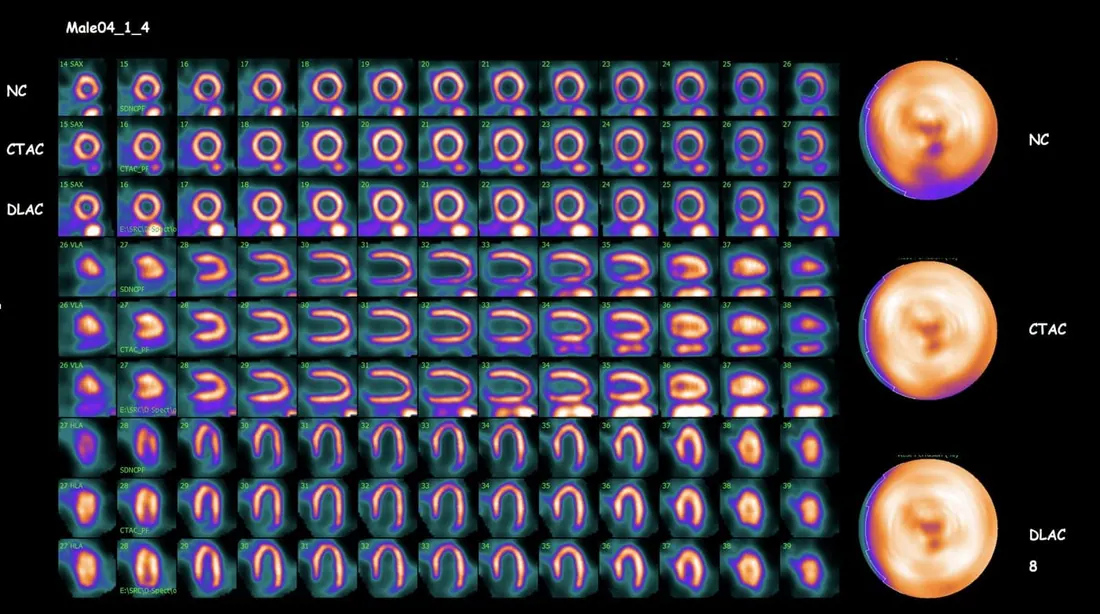 TruCorr Attenuation Correction